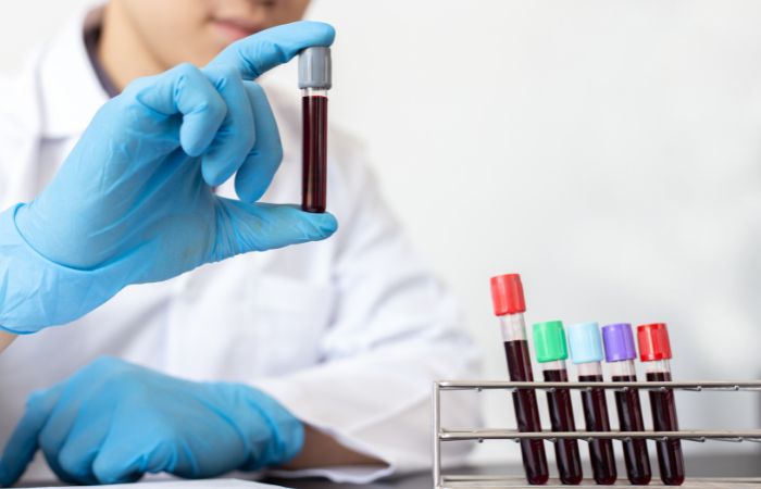 Ammonia Blood Test
